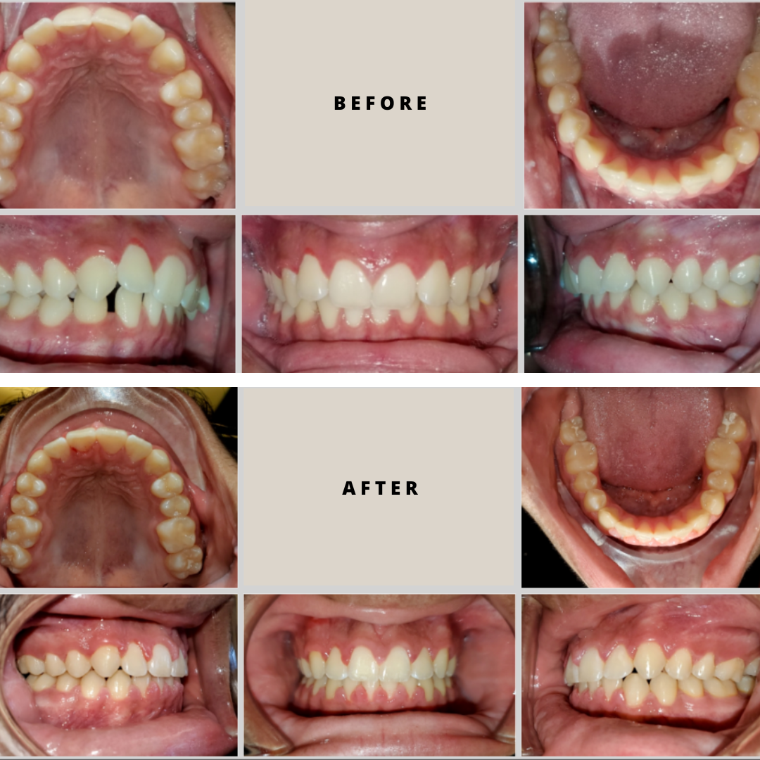 Thousand Smiles Orthodontics Austin | Before and After Orthodontic Treatment