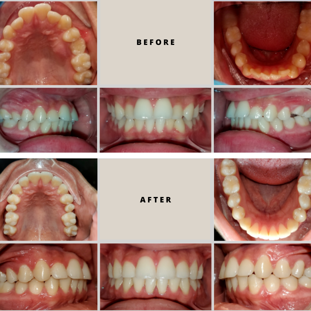 Thousand Smiles Orthodontics Austin | Before and After Orthodontic Treatment