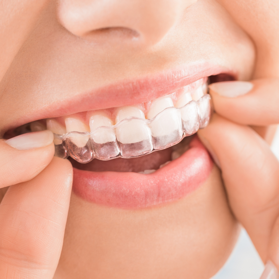 Angel Aligner Orthodontist Near Me