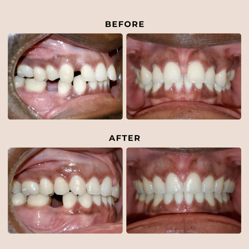 Missing Tooth Orthodontic Treatment Austin | Thousand Smiles Orthodontics