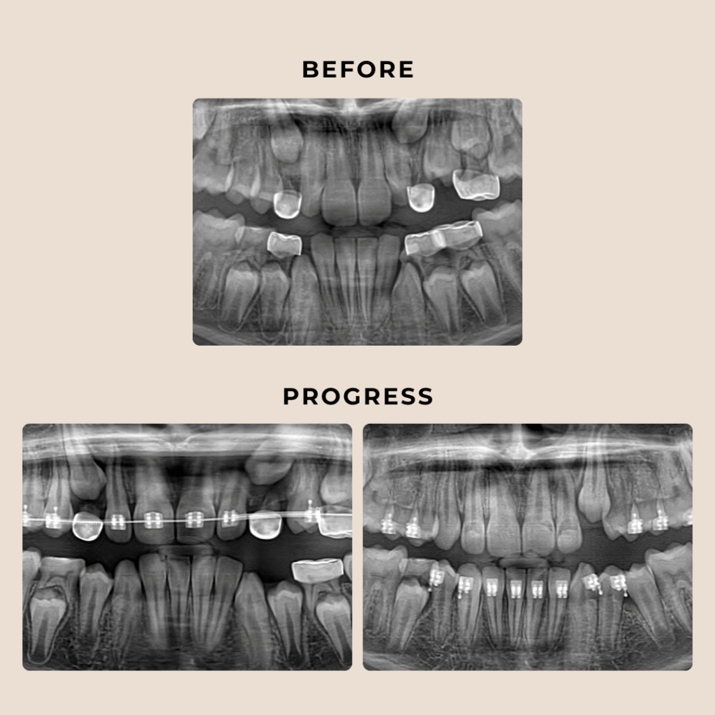 Kids Orthodontist Austin | Thousand Smiles Orthodontics
