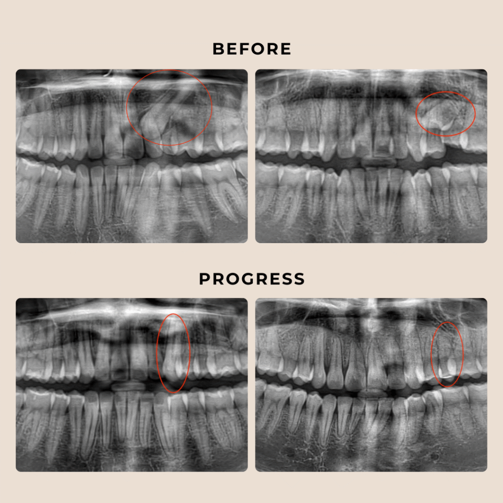 Impacted Tooth Treatment Austin | Austin Orthodontists
