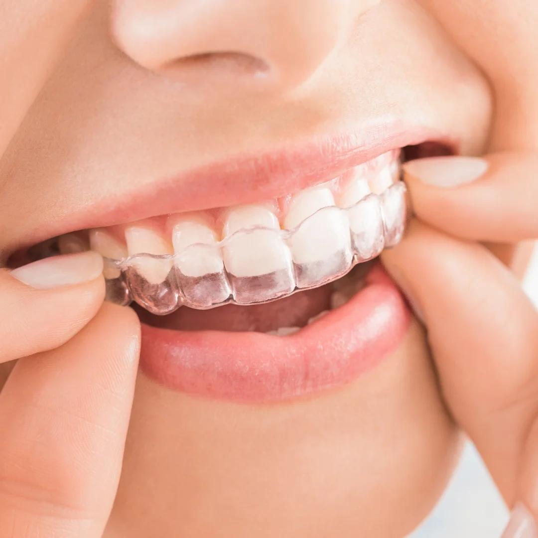 Angel Aligner Orthodontist Near Me